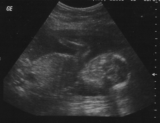 3d ultrasound pictures at 12 weeks. Time went by and at 23 weeks