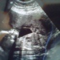 Ultrasound Picture At 21 Weeks